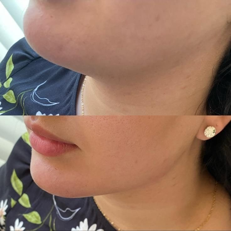 Cheek, chin and jawline filler
